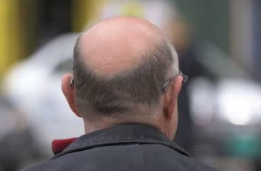 In cura per l’alopecia: ci rimette salute e soldi