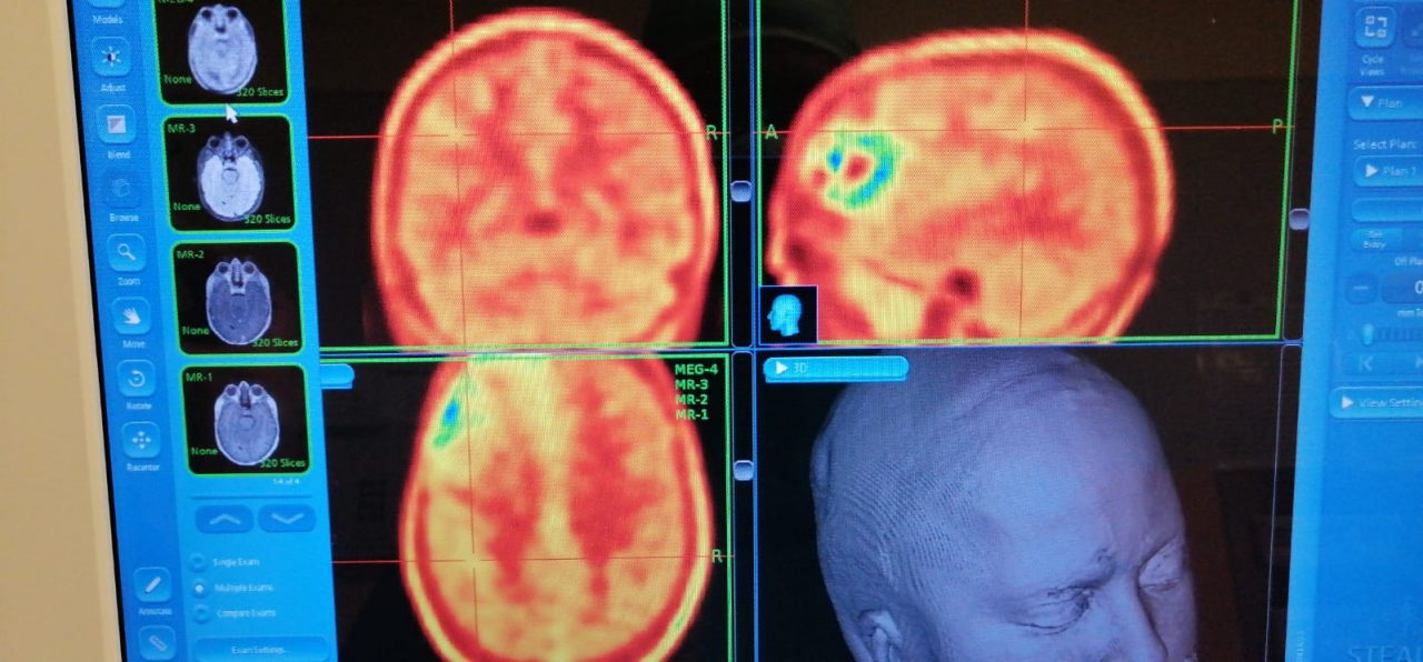 Tumori cerebrali: Firenze e Prato sperimentano nuova tecnica