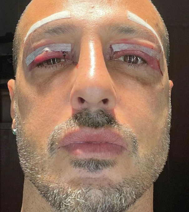 Nuovo intervento estetico per Fabrizio Corona che sogna l’altare con la sua nuova fiamma 