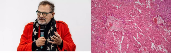 Oliviero Toscani ha una malattia rara. “Non c’è cura, mi resta poco da vivere”