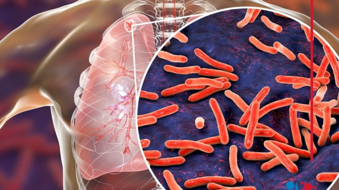 Siena, un caso  di tubercolosi all’istituto tecnico