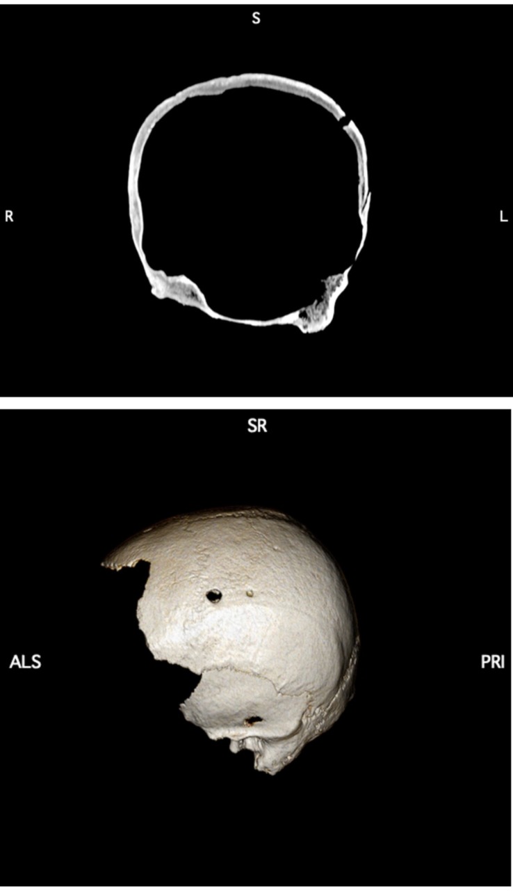 Un cranio, quattro trapanazioni: raro caso di chirurgia medievale